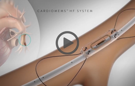 Malfunction with abbott heart failure cardiomes hf system  